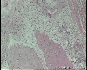 请教，右小腿肌层囊性肿物，肌内粘液瘤？还是肌内粘液囊肿？图4