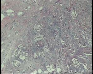 请教老师，69岁乳腺肿物，乳腺浸润性小叶癌吗？图11