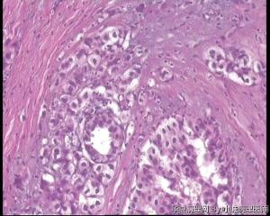 请教老师，69岁乳腺肿物，乳腺浸润性小叶癌吗？图19