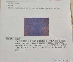 腮腺肿物，请问这是基底细胞癌吗？图1