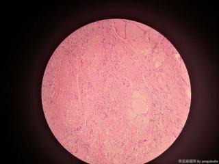 求教各位老师，这个甲状腺是什么癌？图22