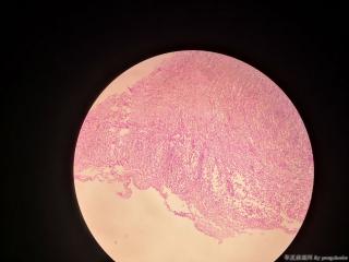 甲状腺囊肿，求教各位老师，这个怎么诊断？图11