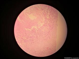 甲状腺囊肿，求教各位老师，这个怎么诊断？图14
