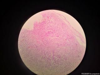甲状腺囊肿，求教各位老师，这个怎么诊断？图12