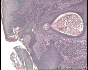 请老师看看面部肿物,老年疣？倒置性角化病？角化棘皮瘤？图6