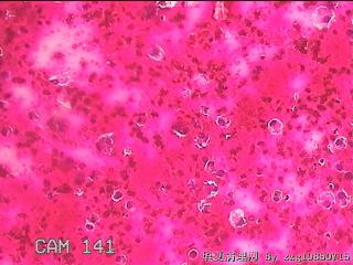 甲状腺穿刺液图2