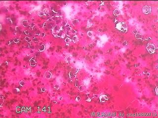 甲状腺穿刺液图24