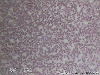甲状腺穿刺液图12