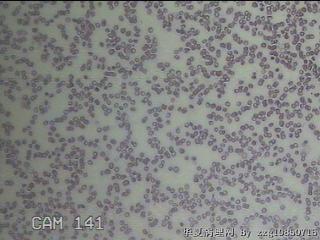 甲状腺穿刺液图11