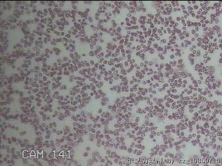 甲状腺穿刺液图21