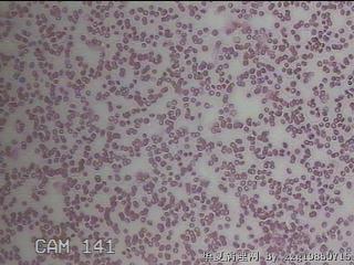 甲状腺穿刺液图24
