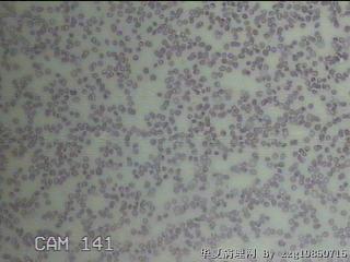 甲状腺穿刺液图17