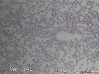 甲状腺穿刺液图6