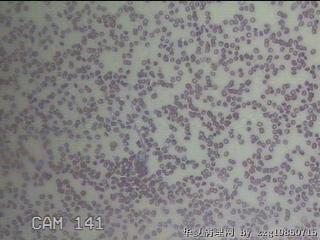 甲状腺穿刺液图4