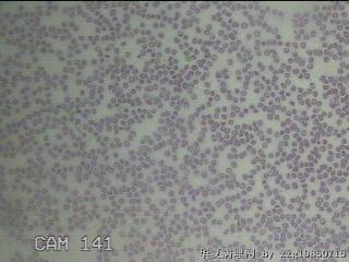甲状腺穿刺液图8