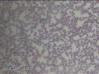 甲状腺穿刺液图14