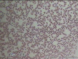 甲状腺穿刺液图23