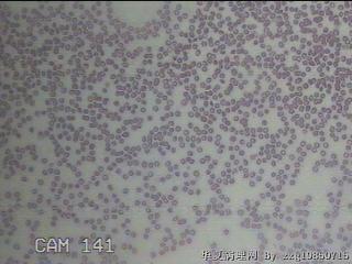 甲状腺穿刺液图5