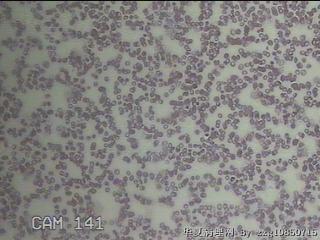 甲状腺穿刺液图16
