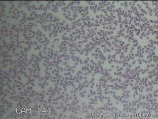 甲状腺穿刺液图18