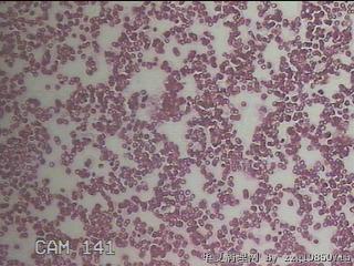 甲状腺穿刺液图29
