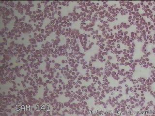 甲状腺穿刺液图28