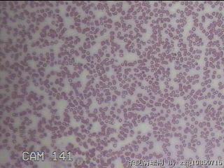 甲状腺穿刺液图32