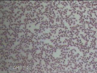 甲状腺穿刺液图20