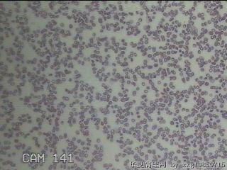 甲状腺穿刺液图9