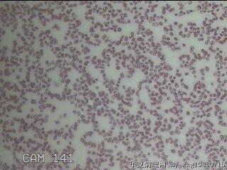 甲状腺穿刺液图22