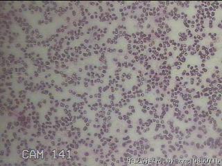 甲状腺穿刺液图1