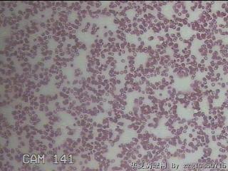 甲状腺穿刺液图25