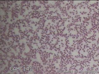 甲状腺穿刺液图27