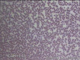 甲状腺穿刺液图31