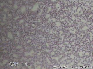 甲状腺穿刺液图13