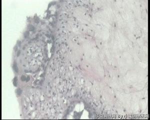 请教，绒毛 水肿还是部分水泡状胎块？图8