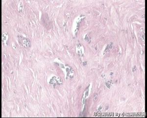 31岁乳腺包块，纤维腺瘤还是腺纤维瘤伴导管上皮增生？图9