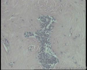 31岁乳腺包块，纤维腺瘤还是腺纤维瘤伴导管上皮增生？图12
