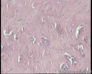 31岁乳腺包块，纤维腺瘤还是腺纤维瘤伴导管上皮增生？图8