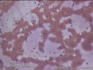 右甲状腺肿物穿刺标本图2