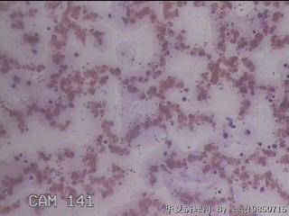 右甲状腺肿物穿刺标本图18