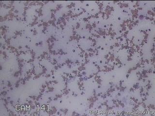 右甲状腺肿物穿刺标本图8