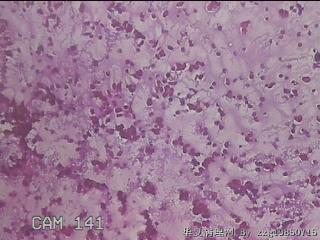 左甲状腺肿物穿刺标本图12