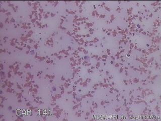 右甲状腺肿物穿刺标本图24