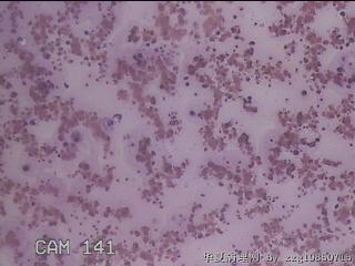 右甲状腺肿物穿刺标本图22