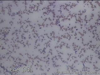 右甲状腺肿物穿刺标本图9