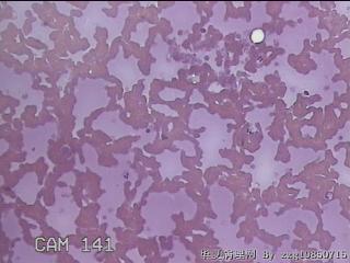 左甲状腺肿物穿刺标本图1