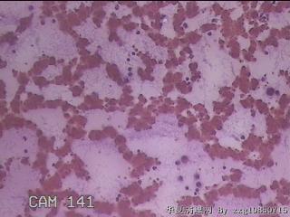 右甲状腺肿物穿刺标本图20