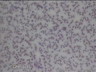 右甲状腺肿物穿刺标本图11