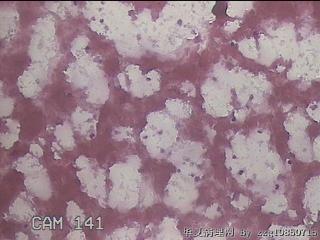 左甲状腺肿物穿刺标本图15